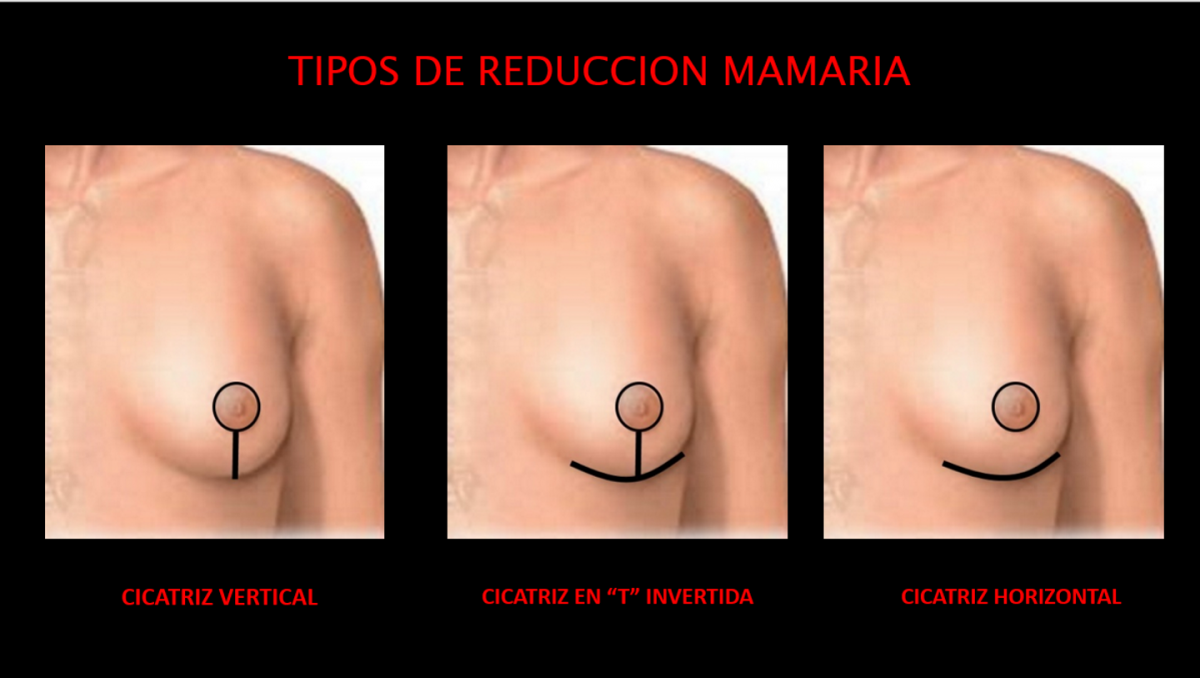 tipos-reduccion-mamaria